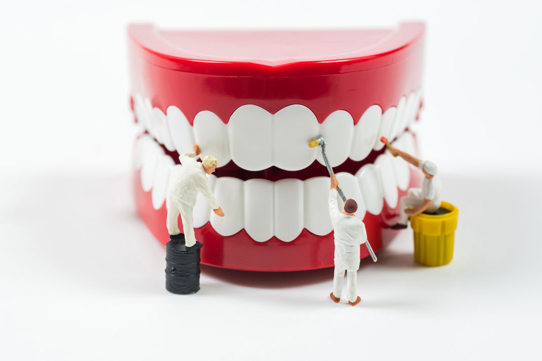 Die Professionelle Zahnreinigung: Ein Frischegefühl von den Profis
