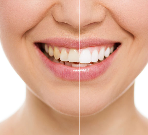 Vorher-/ Nachher-Darstellung einer Bleaching (Zahnaufhellung) Behandlung