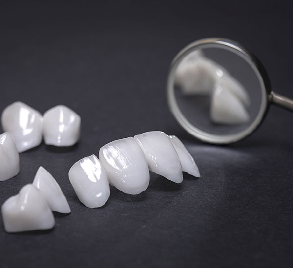 Veneers für kleinere Zahnkorrekturen