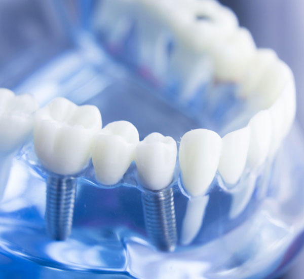 Zahnimplantate Hamburg: Zahnersatz, der wie Ihr eigener Zahn ist
